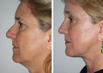 Brow Lift before 91508
