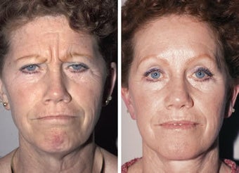 Brow Lift before 91512