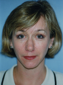 Brow Lift after 319404