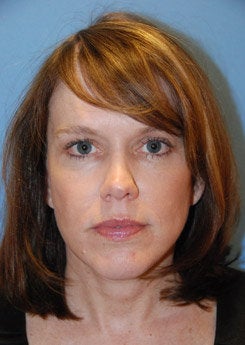 Face Lift, Neck Lift, Brow Lift after 338013