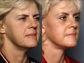 Brow Lift after 338618
