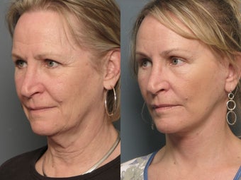Brow Lift after 338627