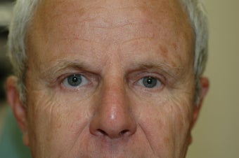Brow lift after 366293