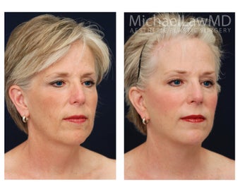 Facial Rejuvenation - Brow Lift after 395401