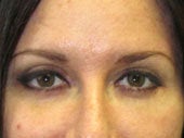 Brow Lift after 541476