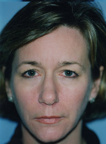 Brow Lift before 319404
