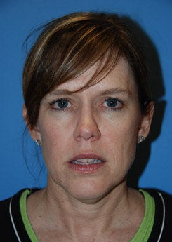 Face Lift, Neck Lift, Brow Lift before 338013