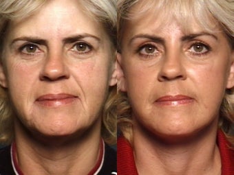 Brow Lift before 338618