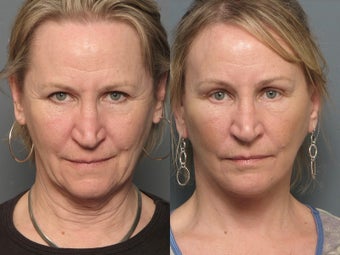 Brow Lift before 338627