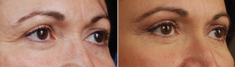 revision upper blepharoplasty-temporal brow lift before 384900