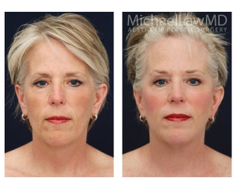 Facial Rejuvenation - Brow Lift before 395401