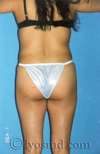 Butock Augmentation before 234984
