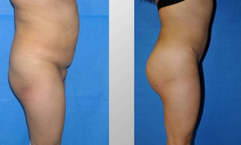 Butt Augmentation before 256429