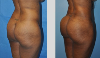 Buttock Augmentation before 271484