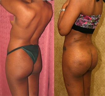 butt augmentation before 242128