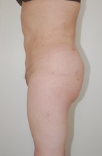 Butt Augmentation after 333881