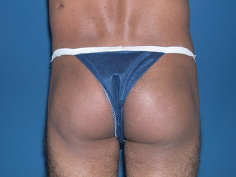Buttock augmentation with implant after 398796