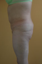 Butt Augmentation before 333881