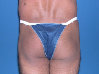 Buttock augmentation with implant before 398796