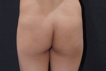 Buttock Augmentation with Gluteal Implant before 411237