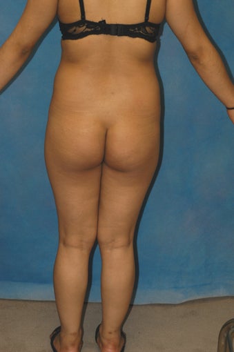 Women's Buttocks Augmentation 518130