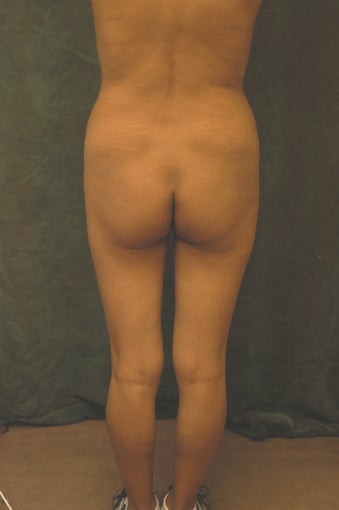 Women's Buttocks Augmentation 518149