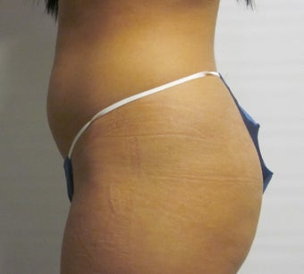 Brazilian Butt Lift 588362