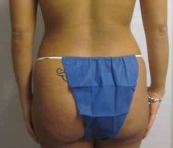 Brazilian Butt Lift before 588362