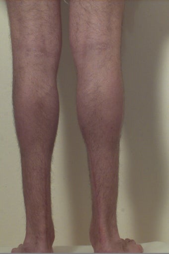 Calf implants after 109607