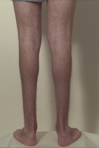 Calf implants before 109607