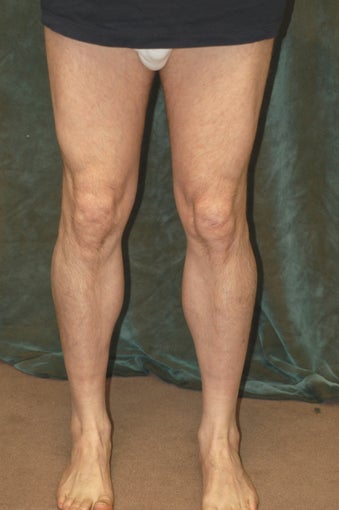 Men's Calf Augmentation 519057
