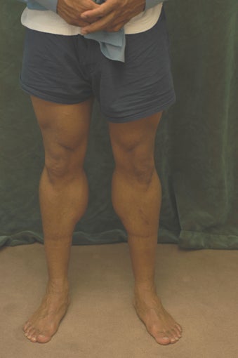 Men's Calf Augmentation 519058