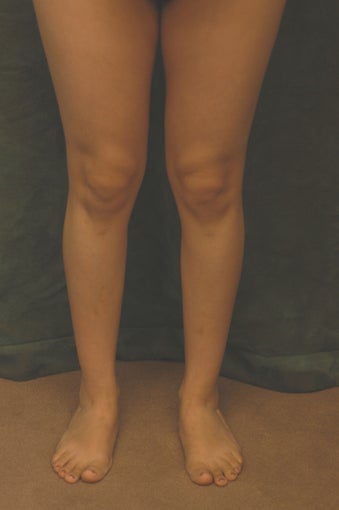 Women's Calf Augmentation 519050