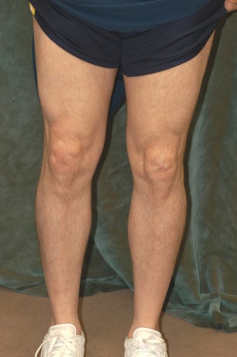 Men's Calf Augmentation 519057