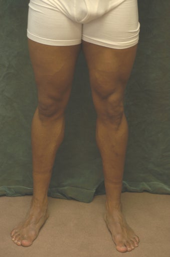 Men's Calf Augmentation 519058