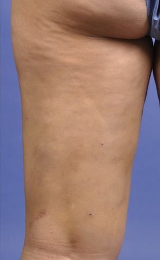Cellulaze after 601314