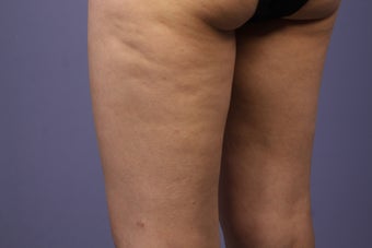 Cellulaze before 576596