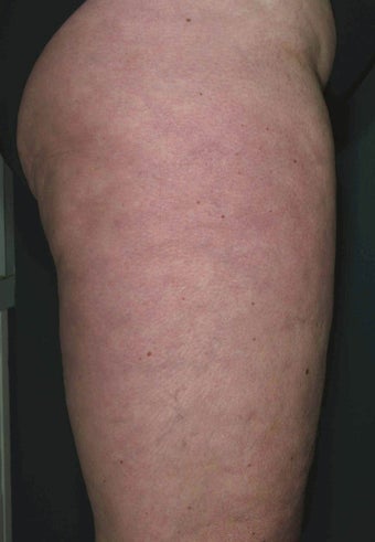 Cellulite treatment after 113274