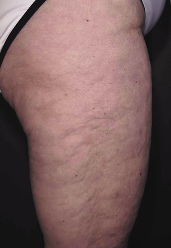 Cellulite treatment before 113274