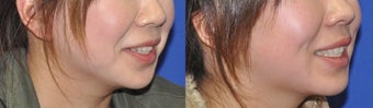 Dimple Creation Surgery before 253242
