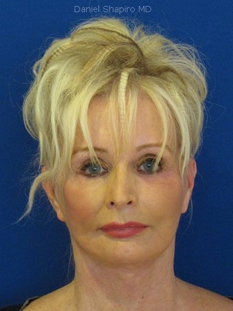 Cheeklift (minifacelift) with TCA chemical peel to the lower eyelids performed in the office under oral sedation with local anes after 249172