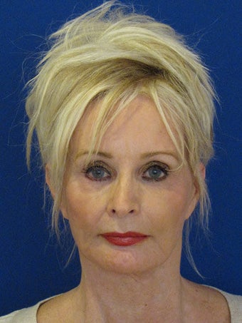 Cheeklift (minifacelift) with TCA chemical peel to the lower eyelids performed in the office under oral sedation with local anes before 249172