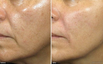 Cheek Augmentation / Cheek Lift before 342418