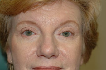 Midface Lift, upper and lower eyelid surgery after 433477