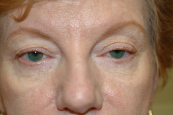 Midface Lift, upper and lower eyelid surgery before 433477