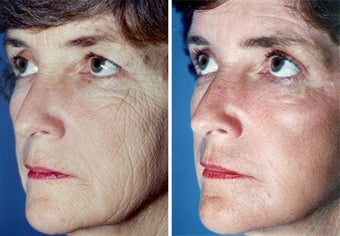 Chemical Peel before 652149