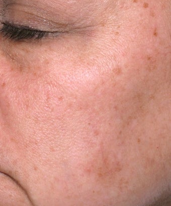 Melanage Peel to Treat Melasma and Hyperpigmentation after 302116