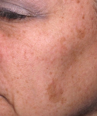 Melanage Peel to Treat Melasma and Hyperpigmentation before 302116