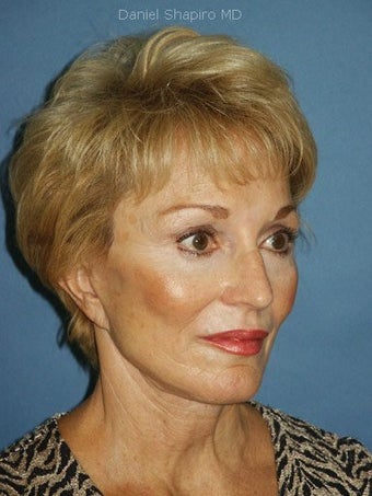 Chin augmentation with facial rejuvenation after 250162