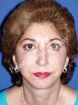 Chin Implants after 622585
